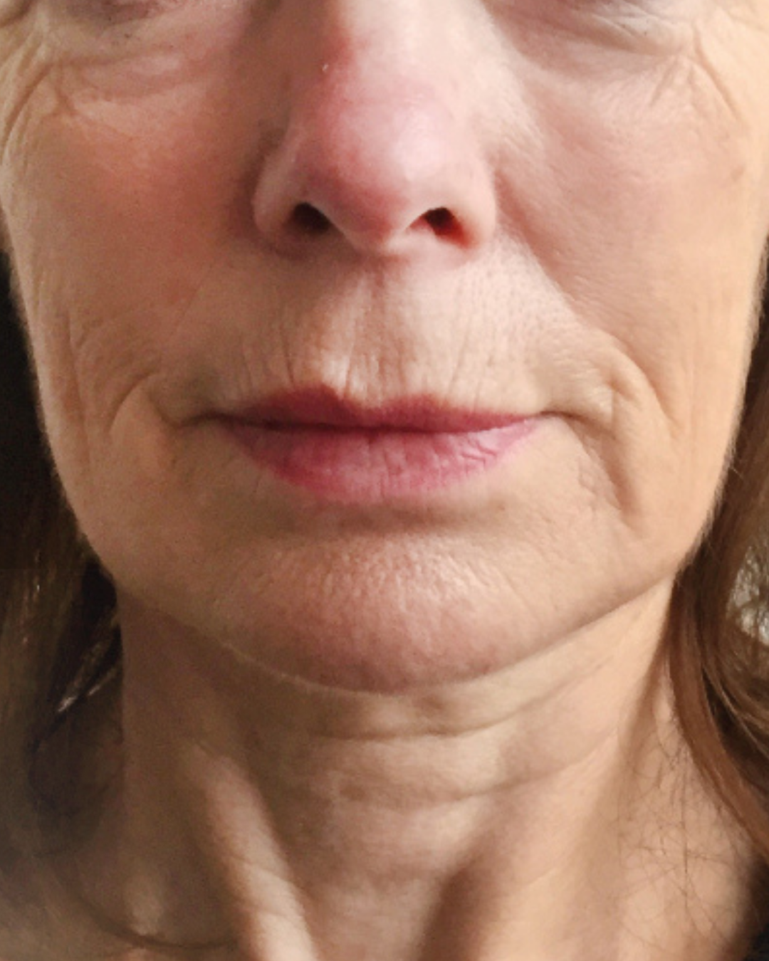 Botox 1