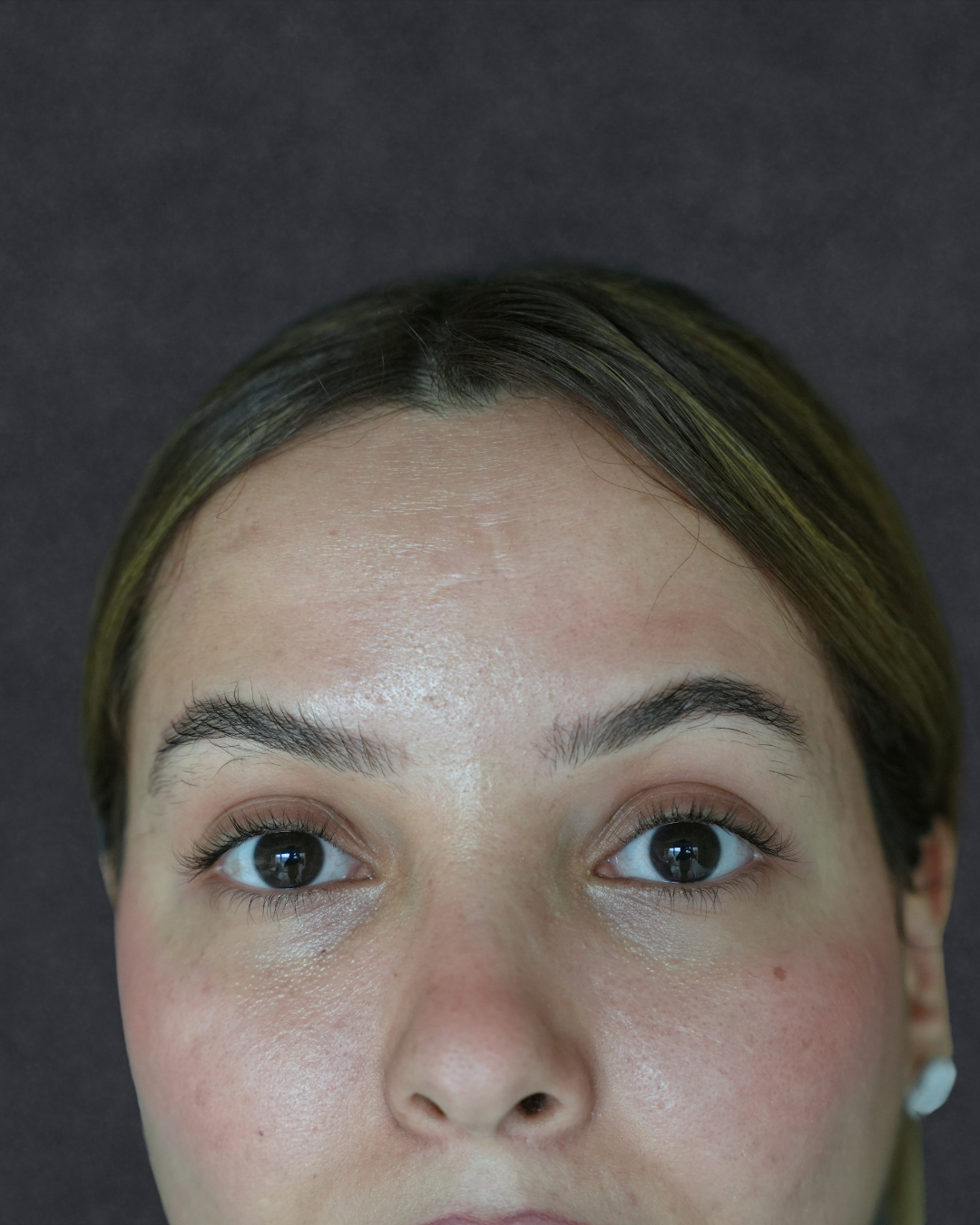 Botox 10