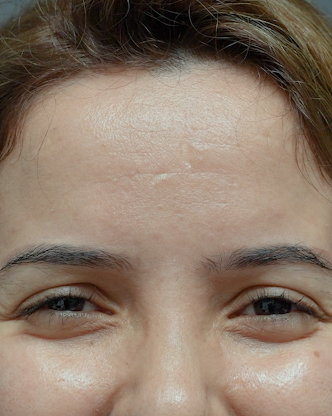 Botox 11