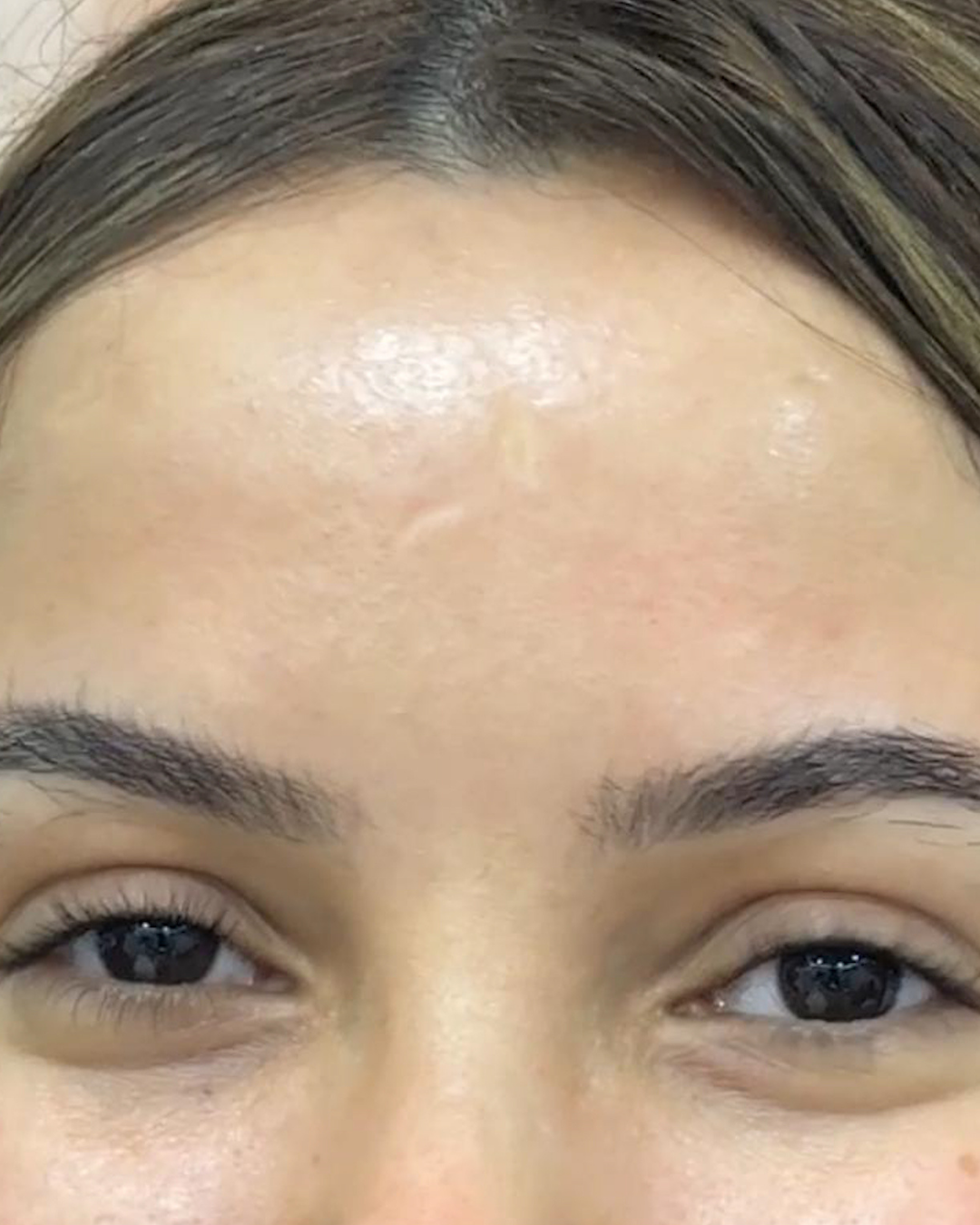 Botox 12