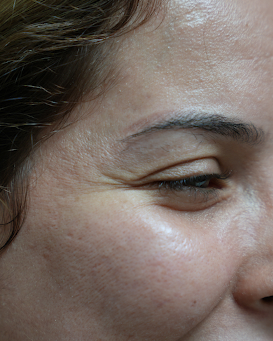 Botox 13