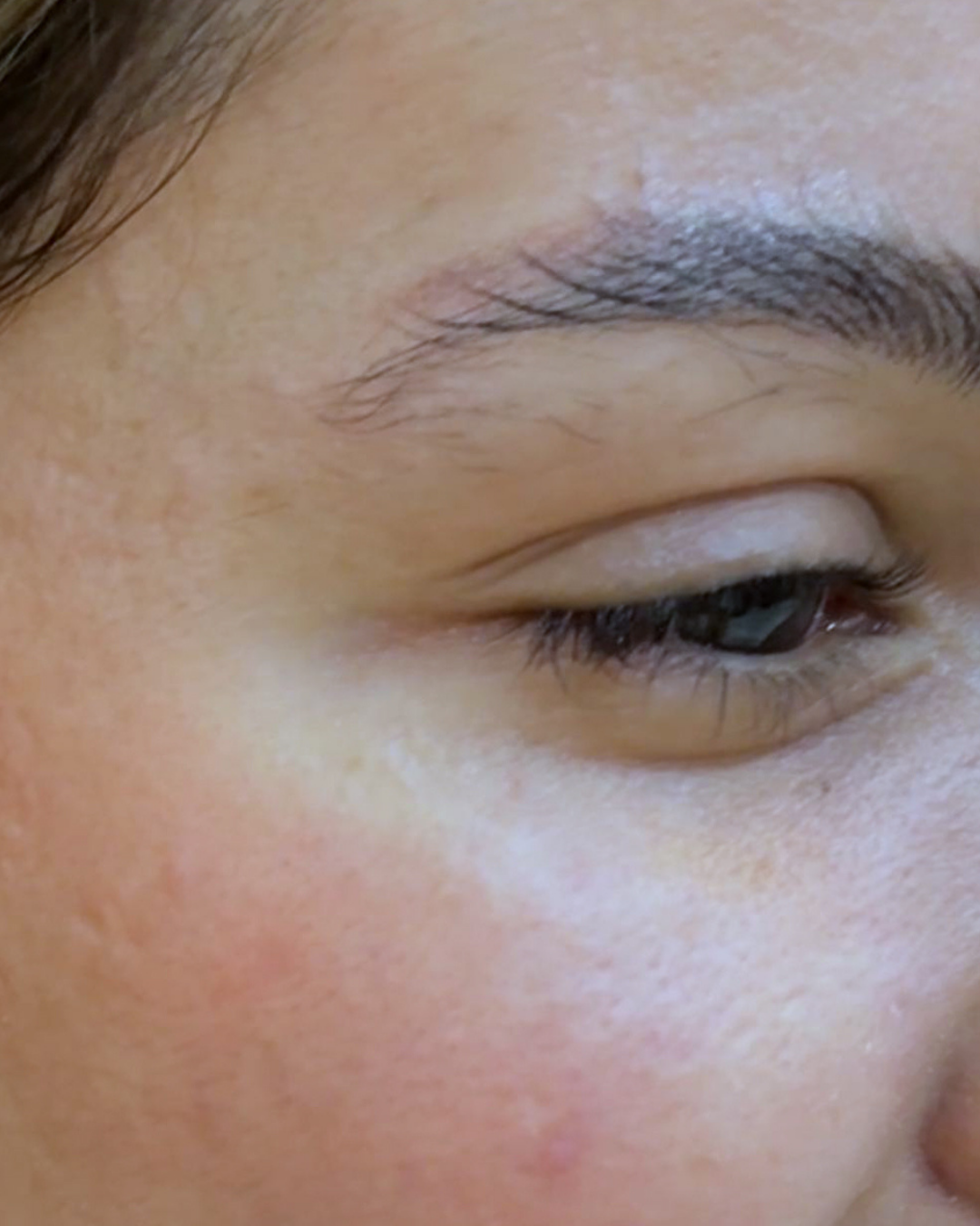 Botox 14