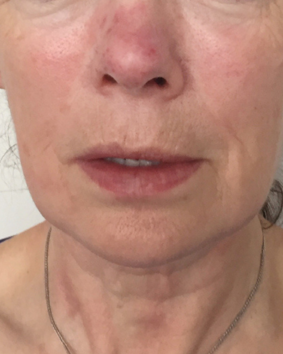 Botox 2