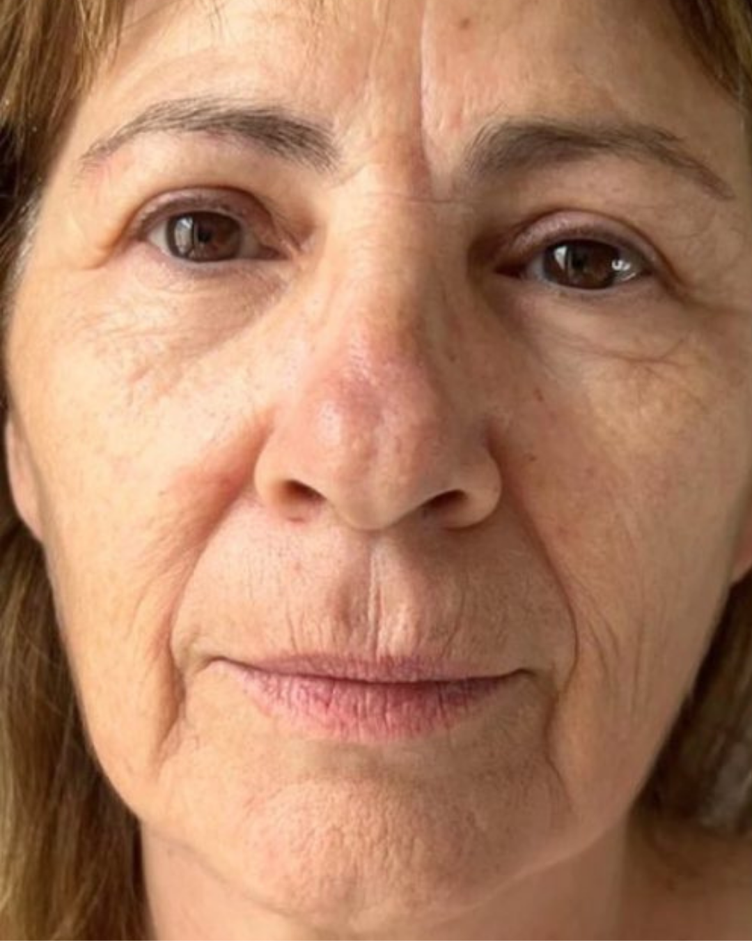 Botox 3