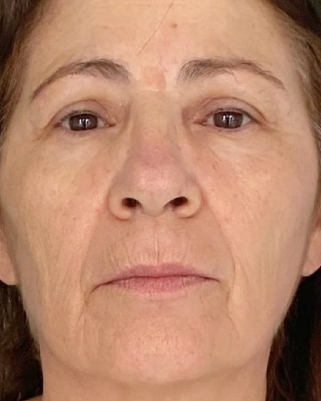 Botox 4