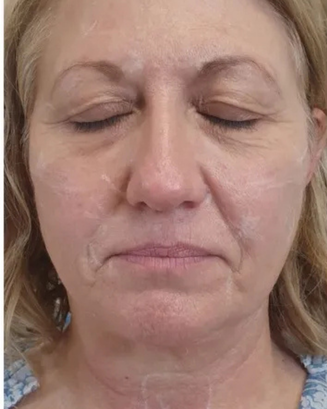 Botox 5
