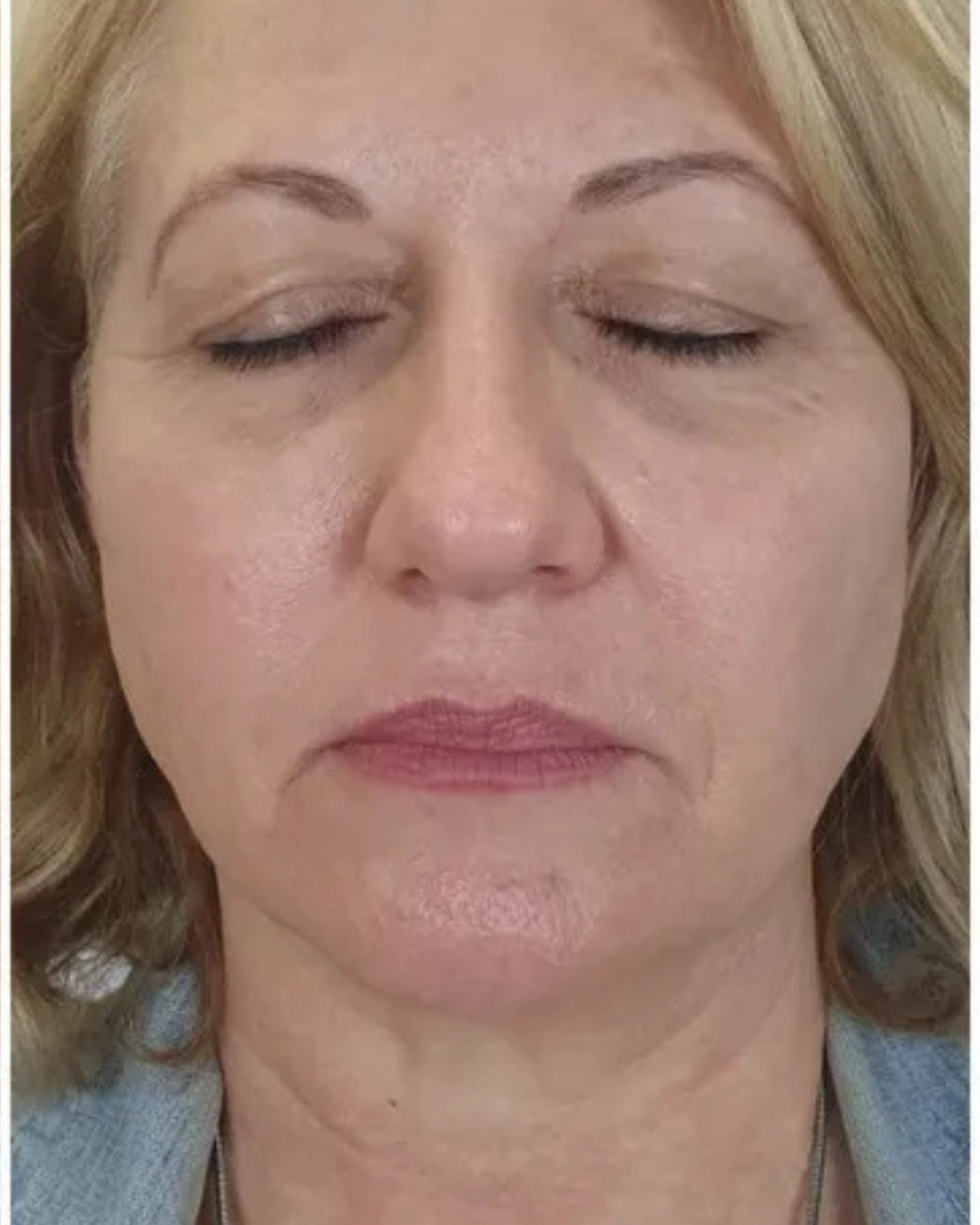 Botox 6