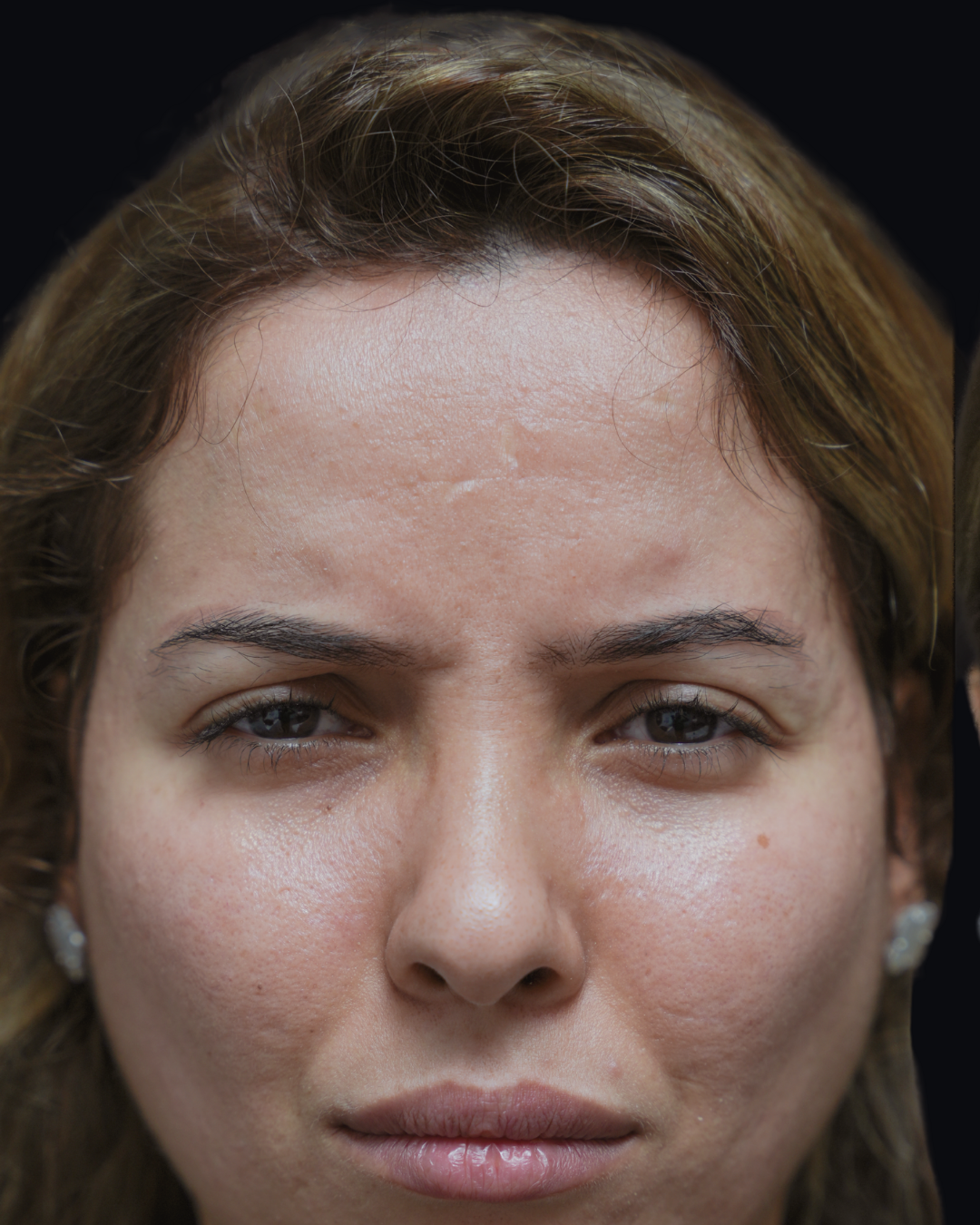 Botox 7
