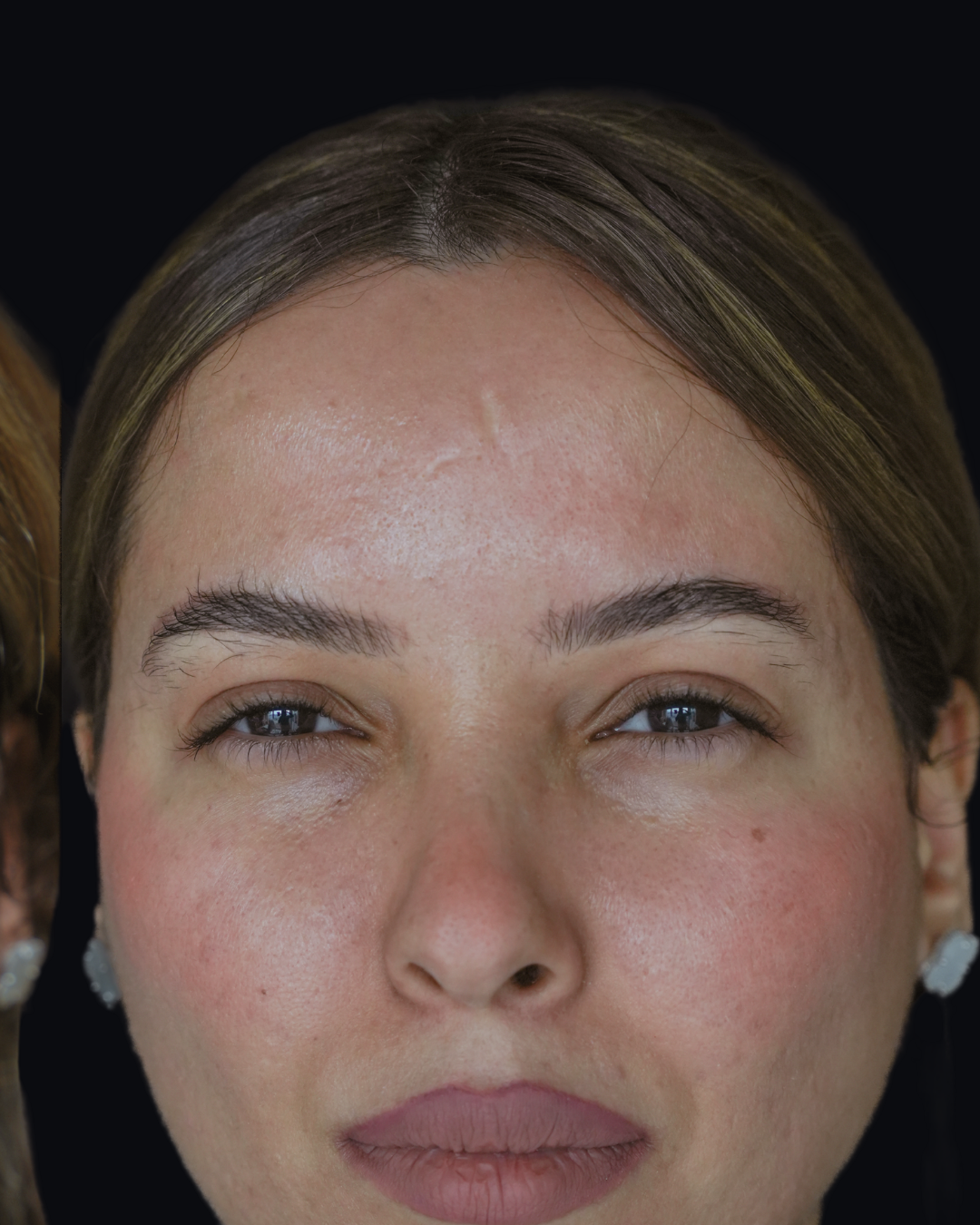 Botox 8