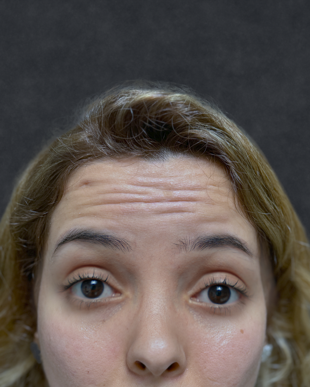 Botox 9