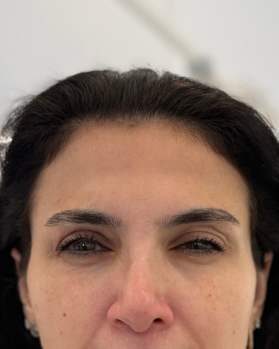 Botox after