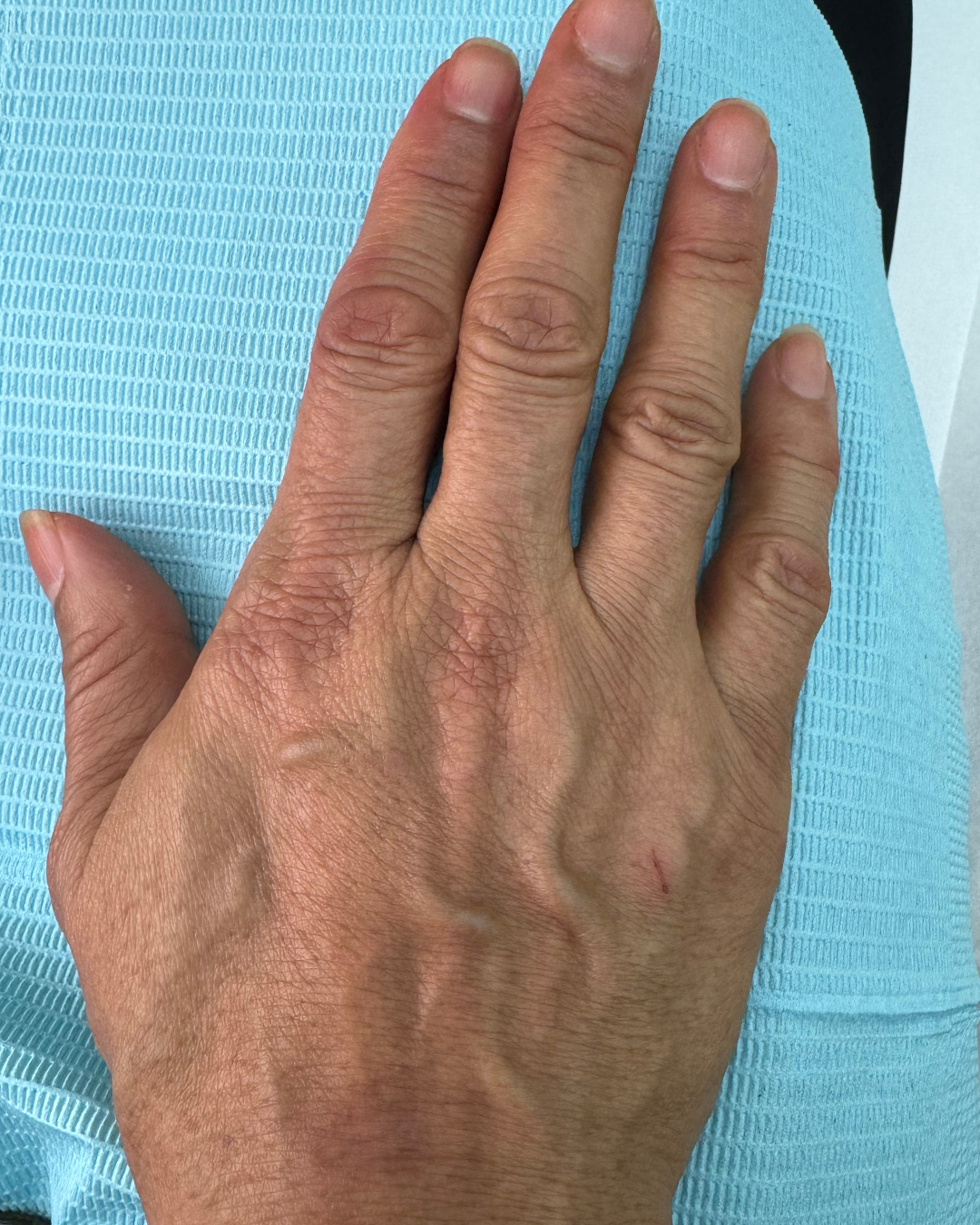 Hand filler 5