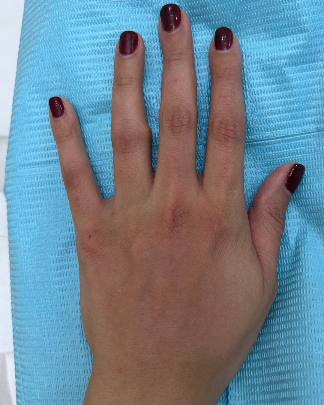Hand filler 8