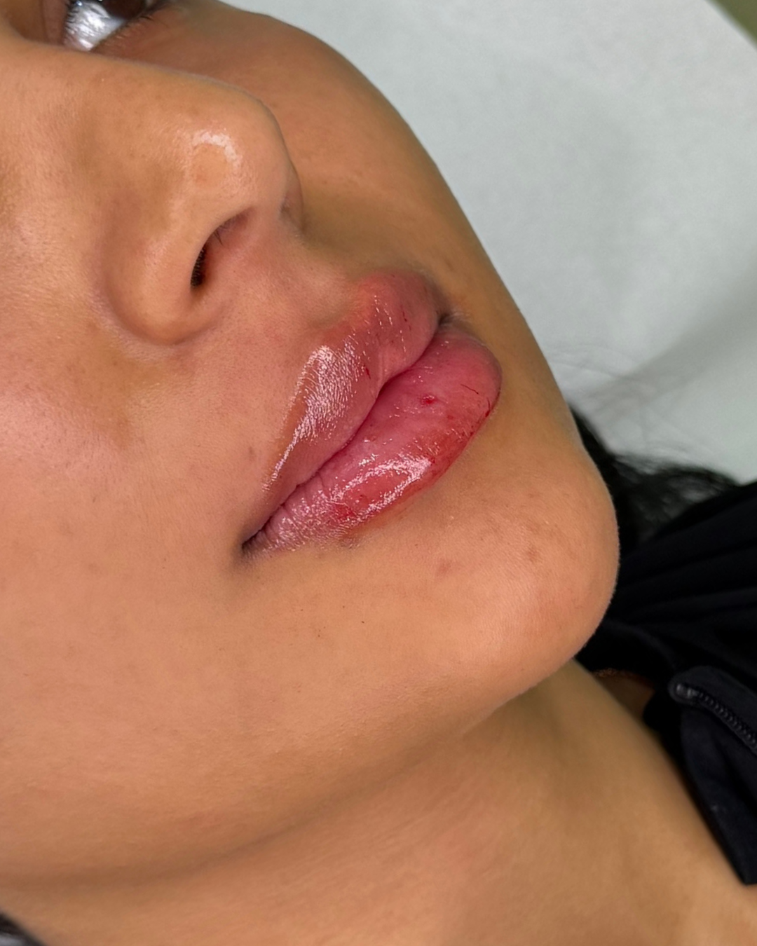 Lip filler 1