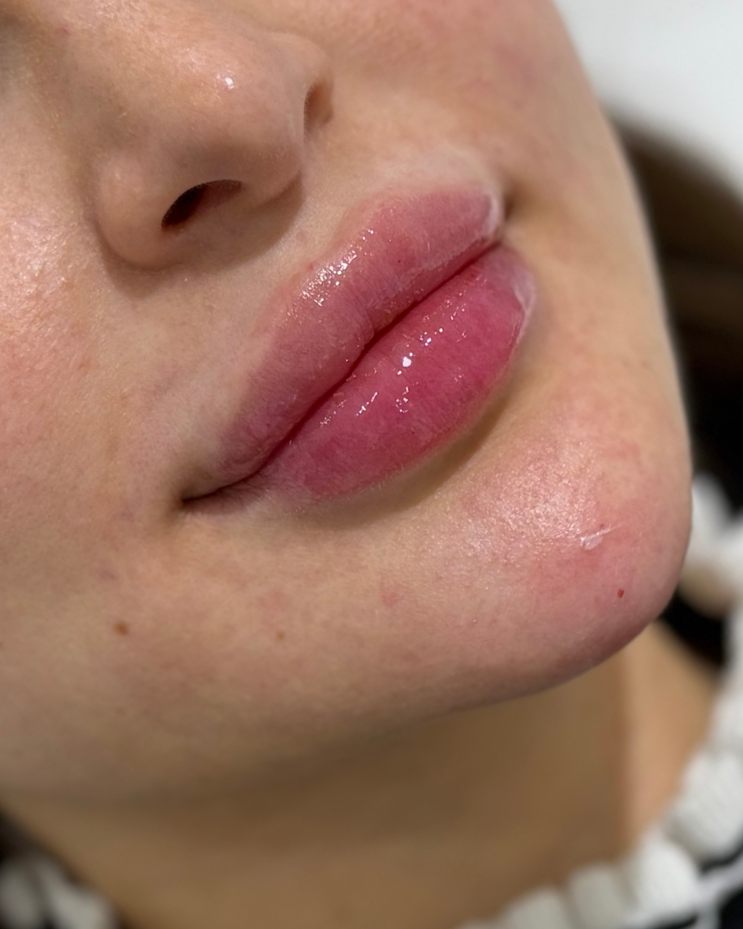 Lip filler 2