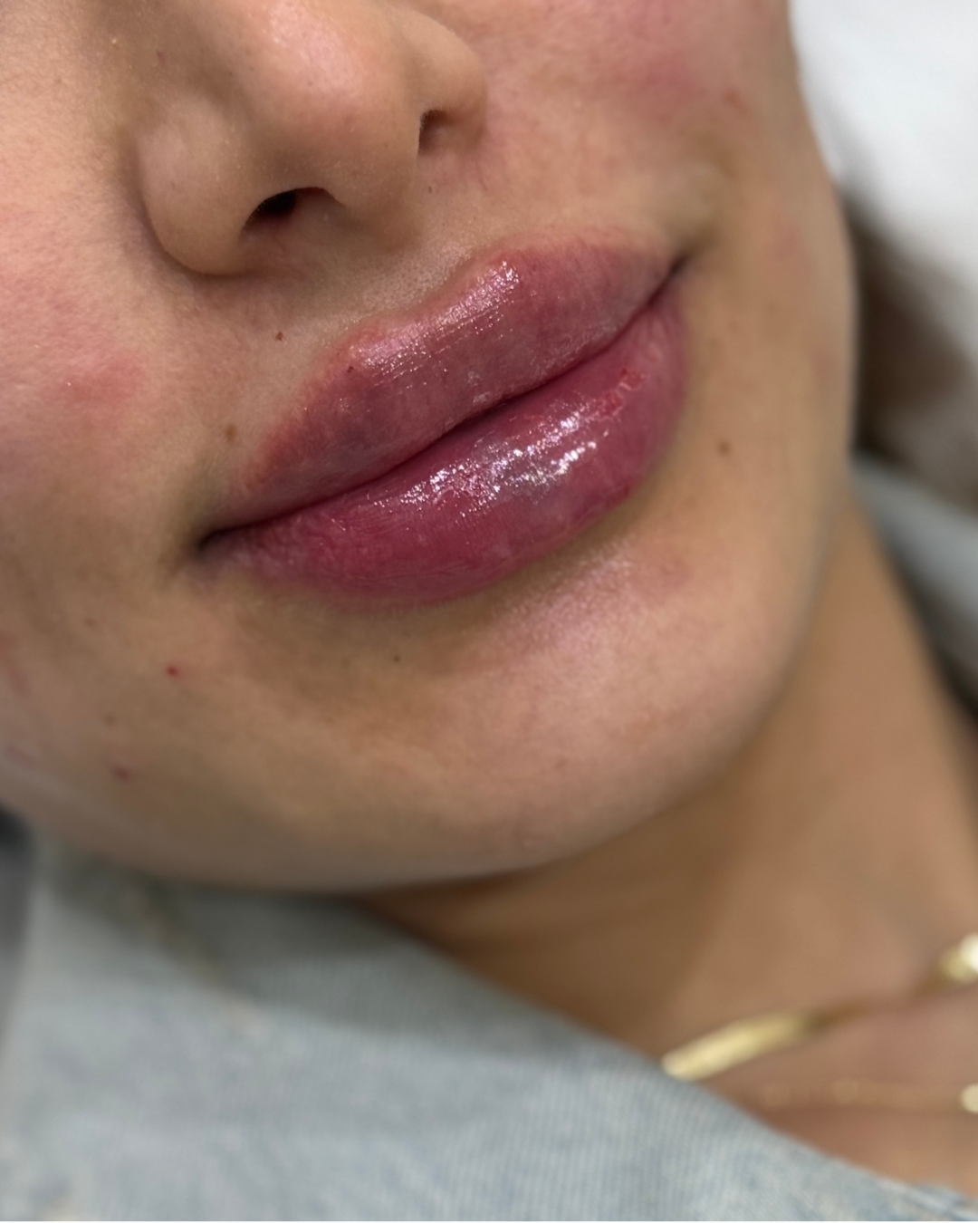 Lip filler after (2)