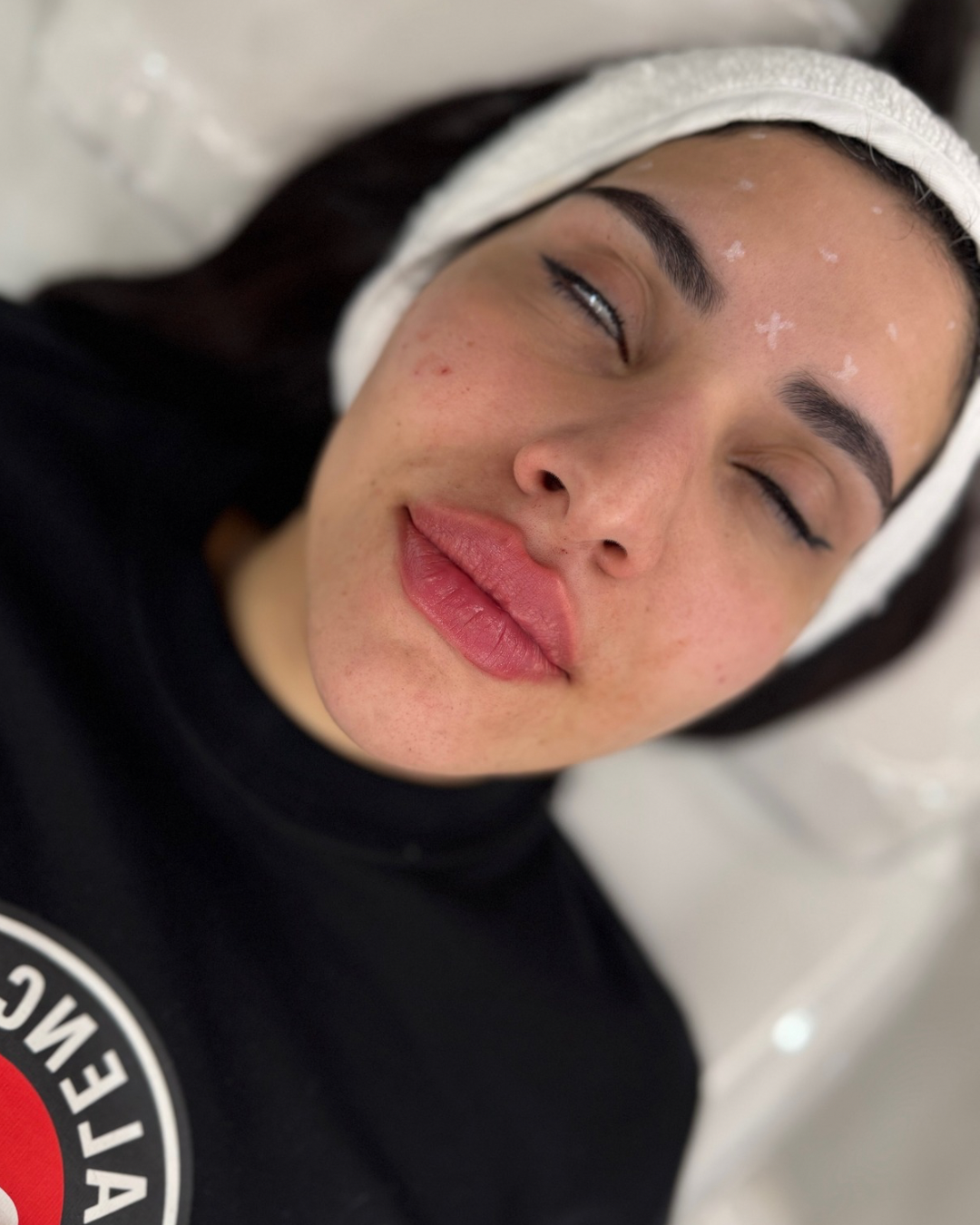 Lip filler after (5)