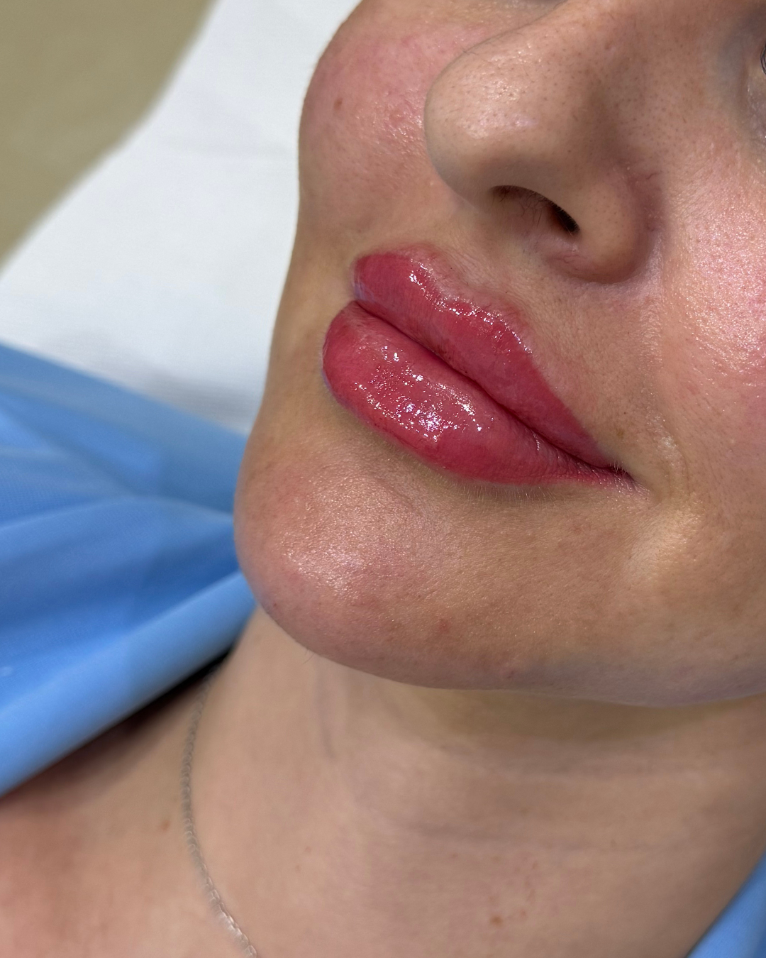 Lip filler after (6)