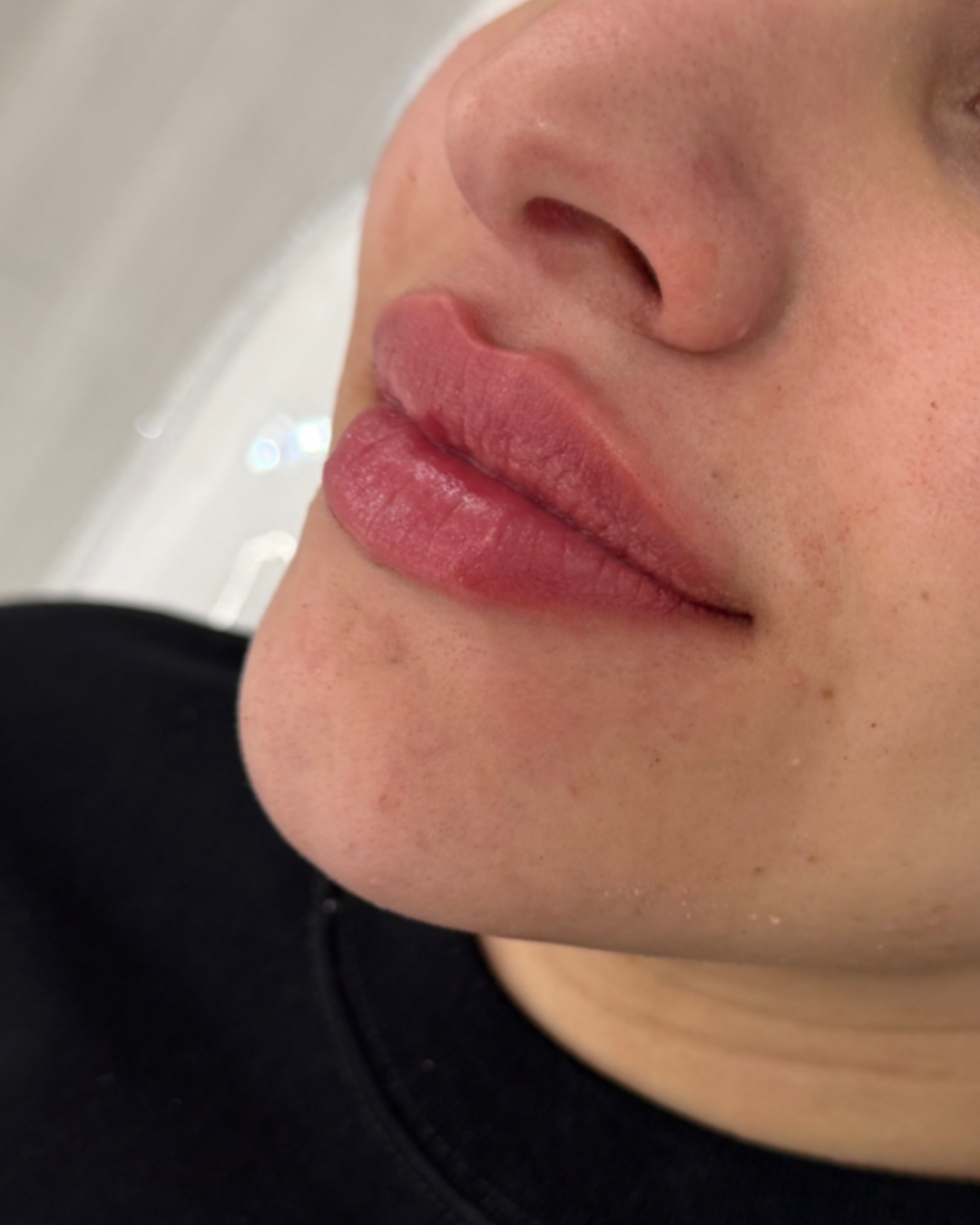 Lip filler after (7)