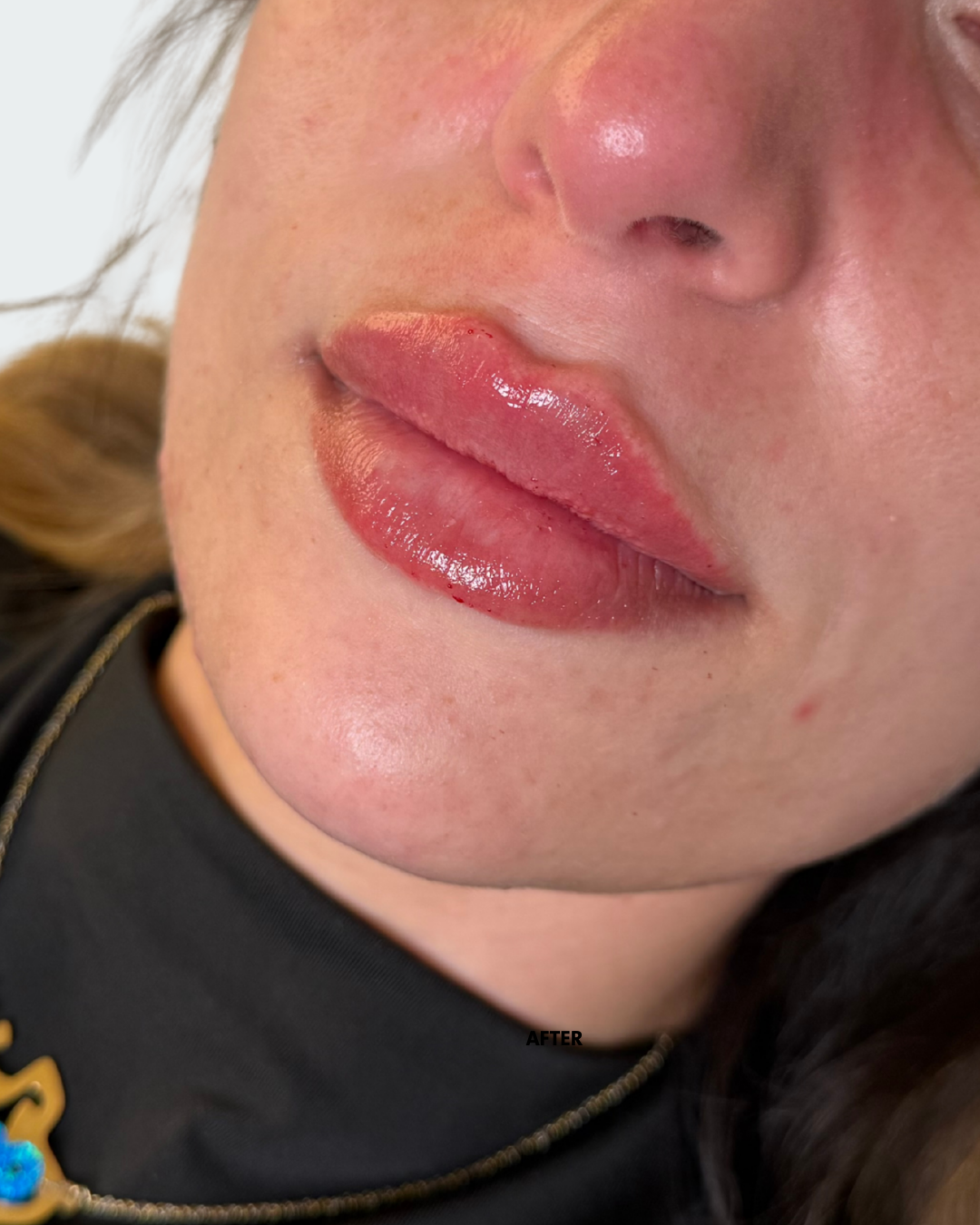 Lip filler after