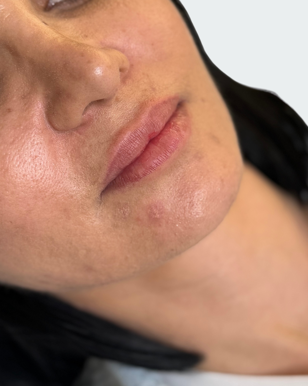 Lip fillers 1