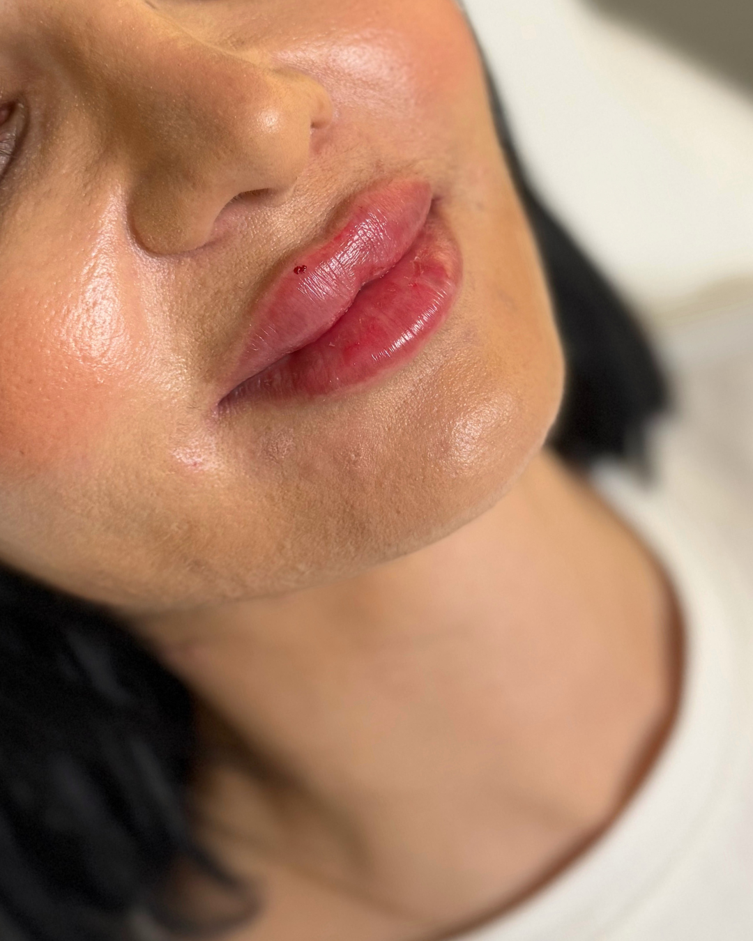 Lip fillers 2