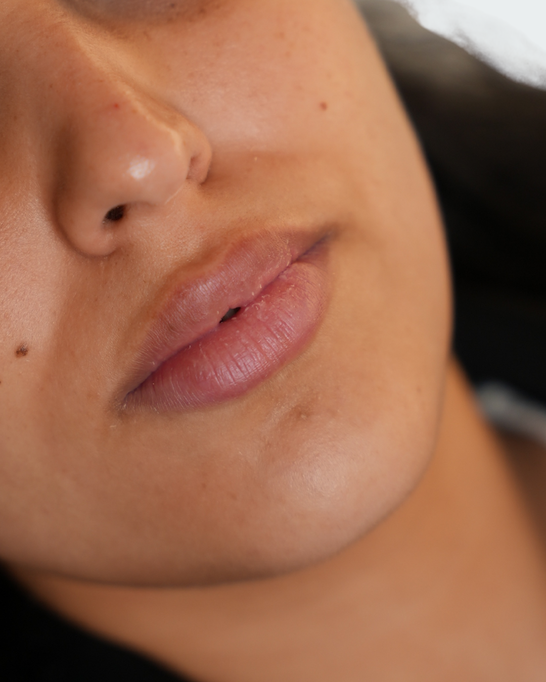 Lip fillers 3
