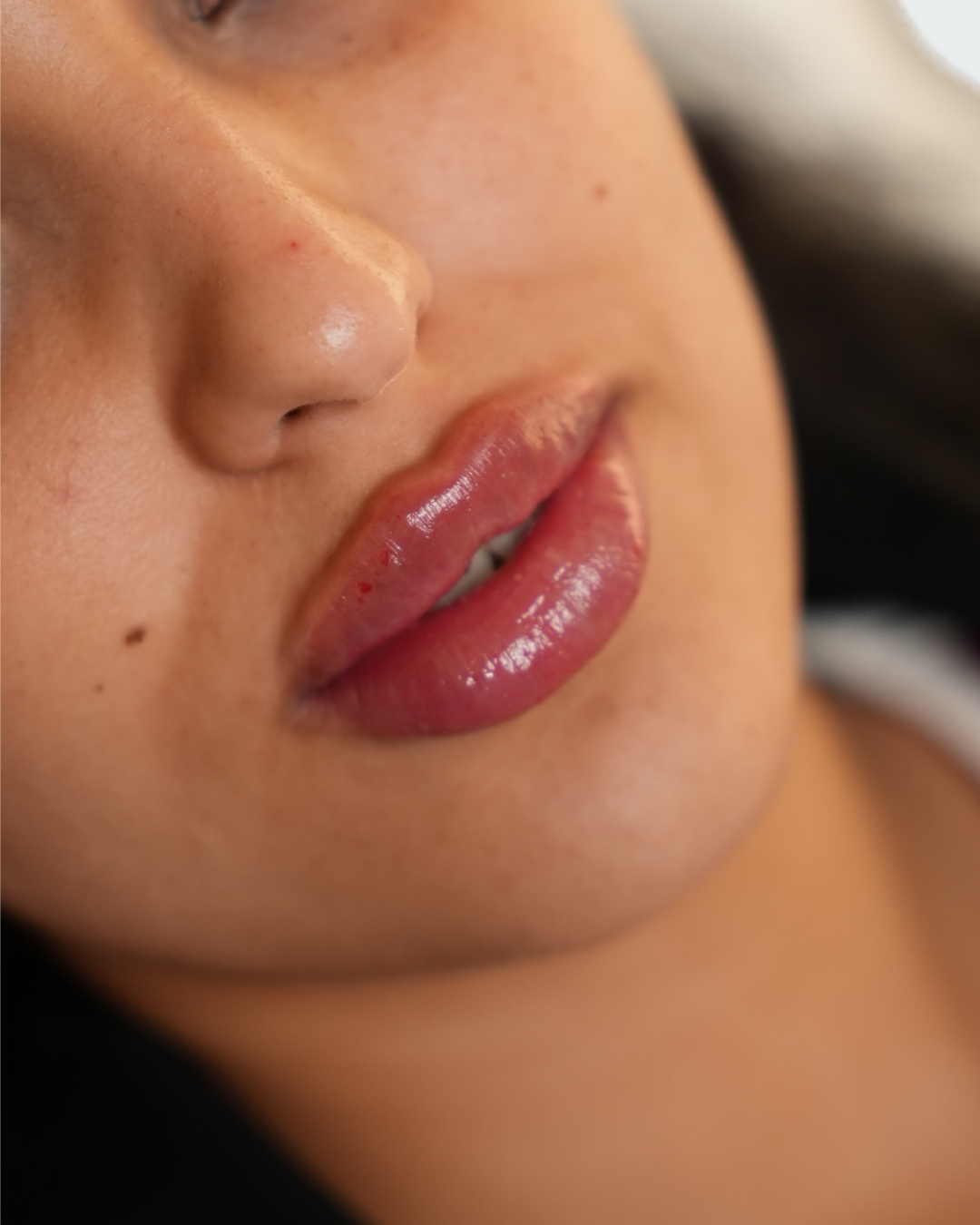 Lip fillers 4