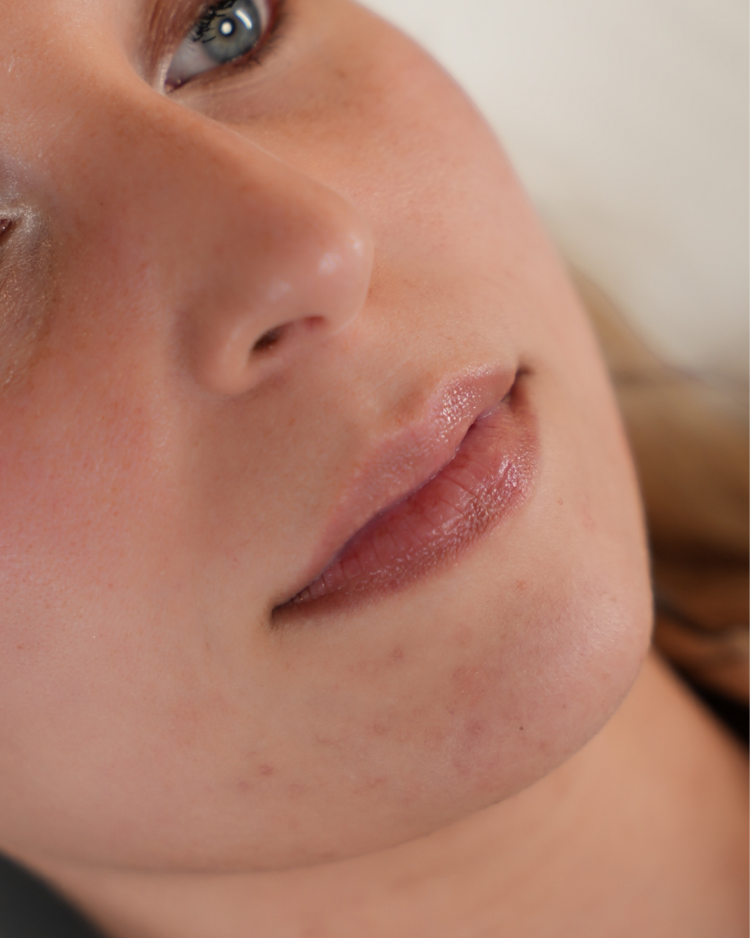 Lip fillers 5
