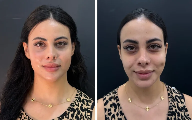 injectables before & After