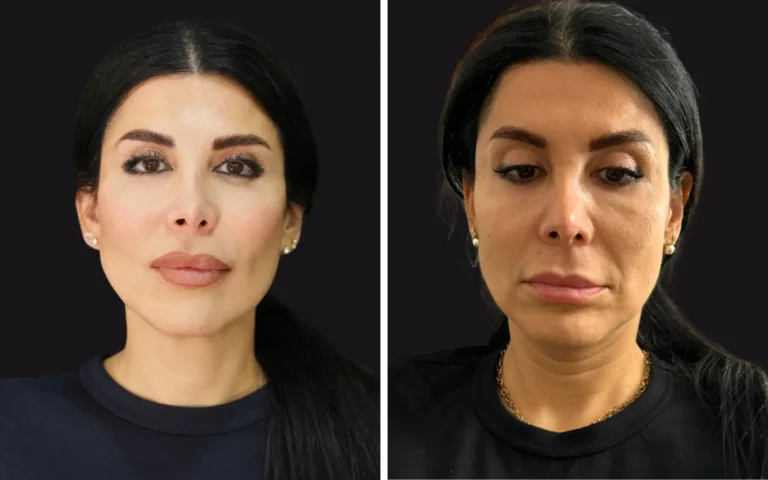 skin tightening b&A