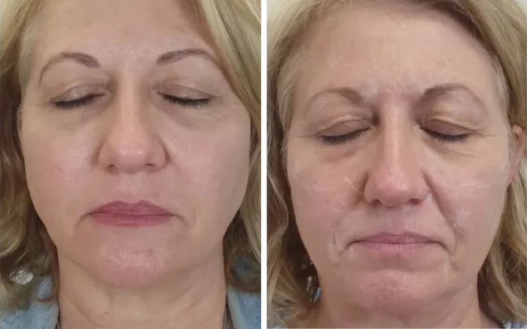 skin treatment b&a